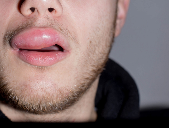 Наследственный ангиоотек: новая информация для специалистов